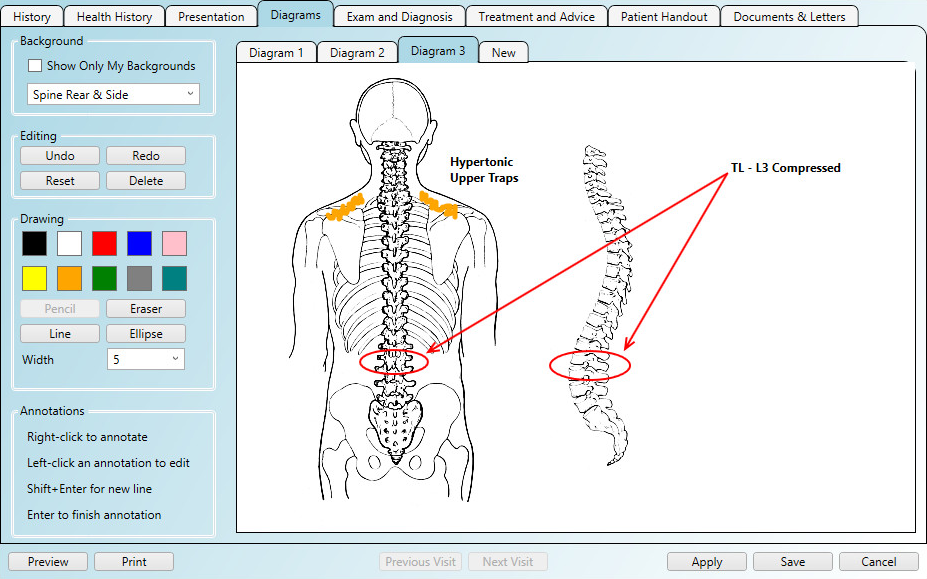 Using chiropractic diagrams in the patient notes area of the software